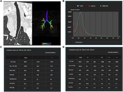 Radiological patterns and pulmonary function values of lung involvement in primary Sjögren’s syndrome: A pilot analysis